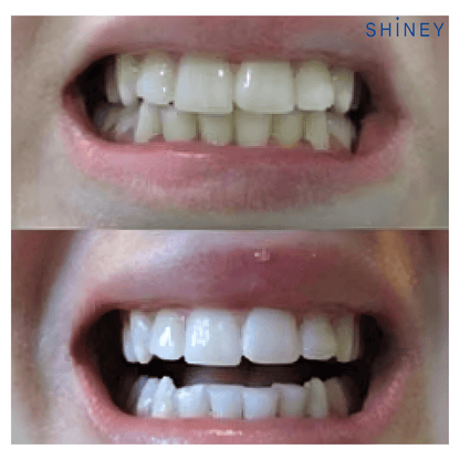 Shiney® ערכה ביתית להלבנת השיניים - Shiney ישראל